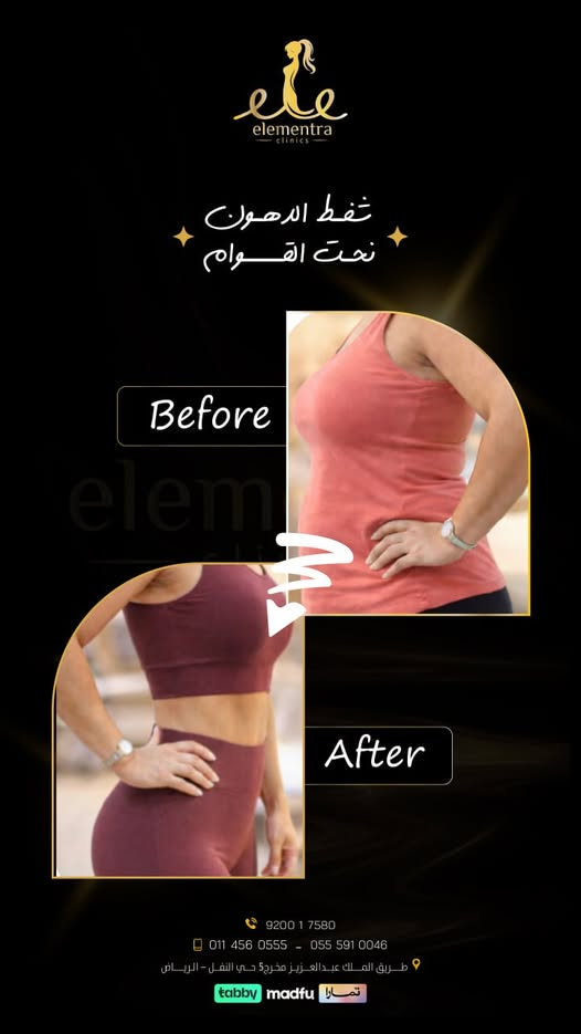 #شفط_الدهون #نحت_القوام #BodyContouring #قبل_وبعد #جراحة_تجميل #ElementraClinics
