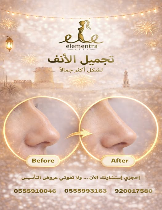 تجميل ، تجميل الأنف ، أنف متناسق ، جراحة ، جراحة تجميل ، عيادات ، عيادات تجميل ، جمال ، جمال طبيعي ، تجميل السعودية ، ثقة وجاذبية ، ملامح ، ملامح أجمل ، السعودية ، الرياض
